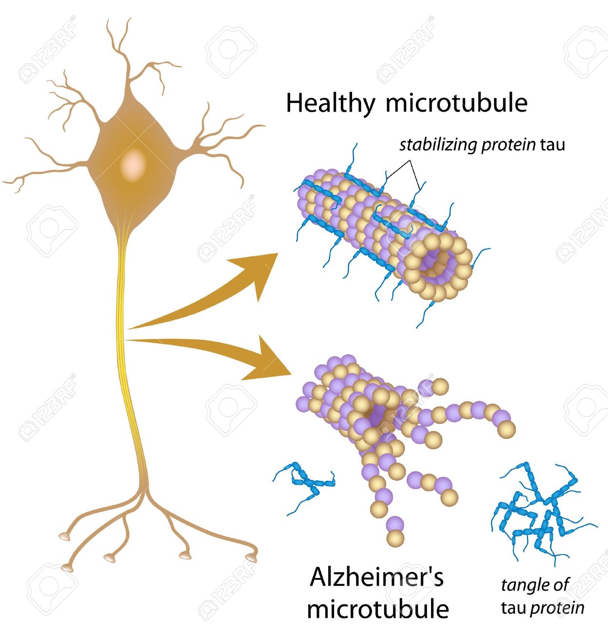 15688229 disintegrating microtubules in alzheimer disease